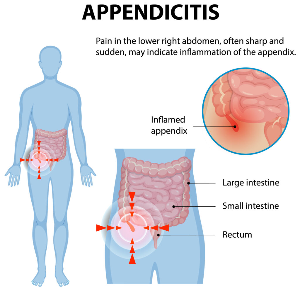 Understanding Appendicitis Key Signs Symptoms And When To Seek Help